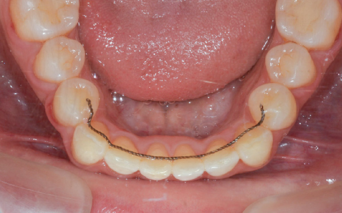 画像：歯並びの健康管理を忘れないこと（長期フォローアップ）