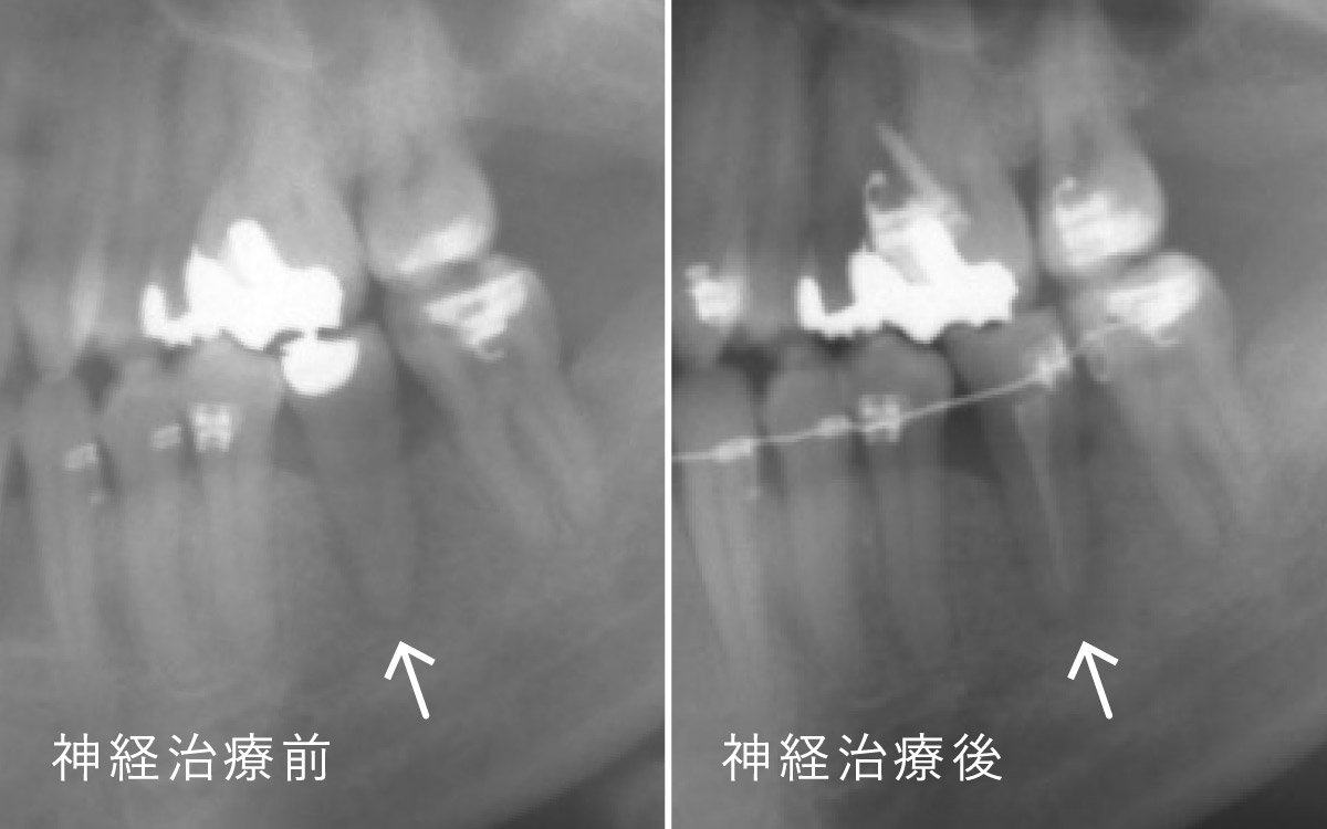画像：移植歯の根の神経治療（移植後3〜4週間後）