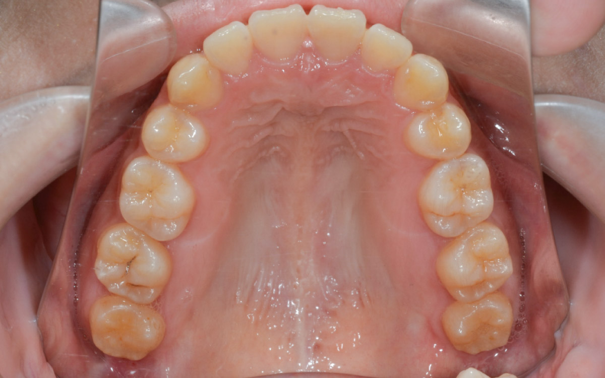 画像：矯正歯科治療を受けて大きく歯列が変化した