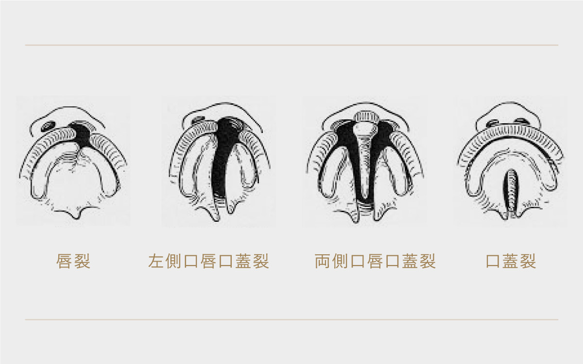 口唇口蓋裂手術とは何ですか?