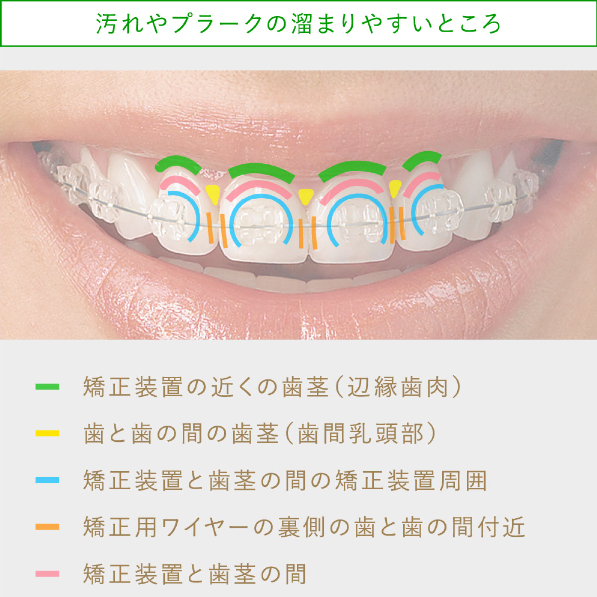 画像：通院毎に定期的な歯磨き指導
